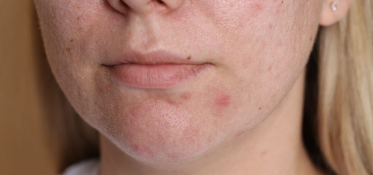 Best acne spot treatment for fast pimple healing using effective ingredients like benzoyl peroxide and salicylic acid