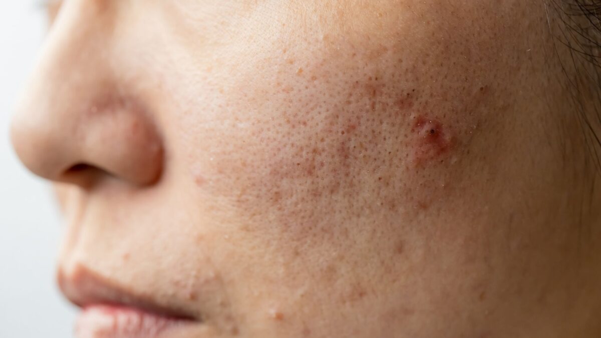 best acne spot treatment for women with different acne treatment products