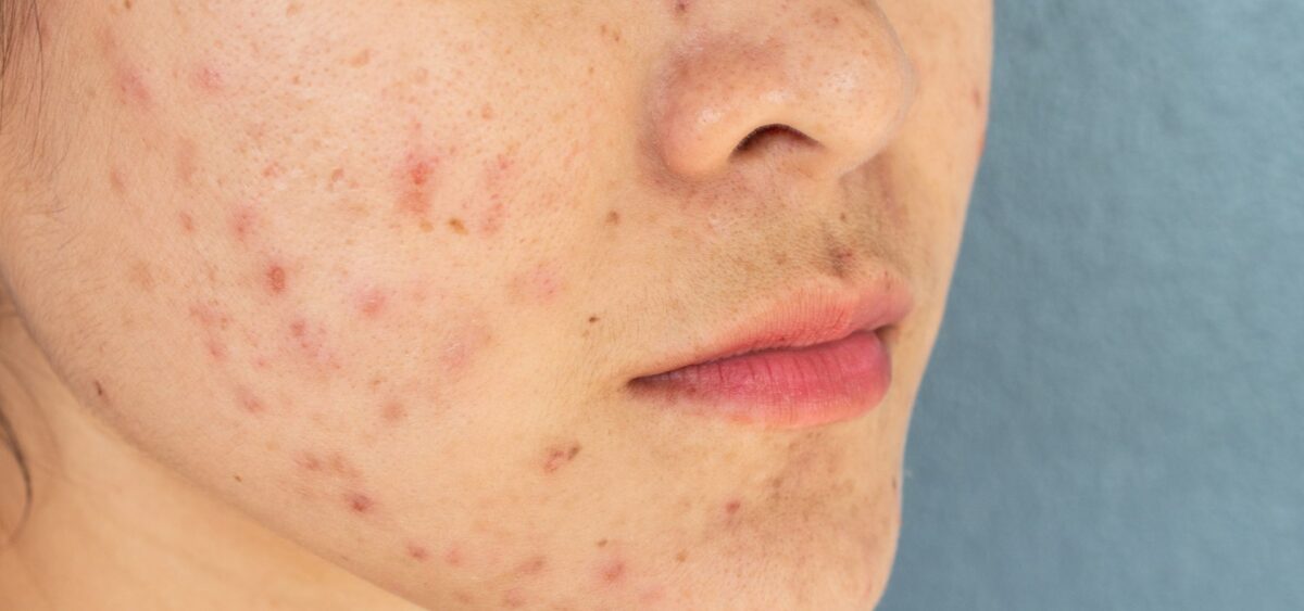 Best ingredients for hormonal acne including salicylic acid, niacinamide, and retinol for clearer skin
