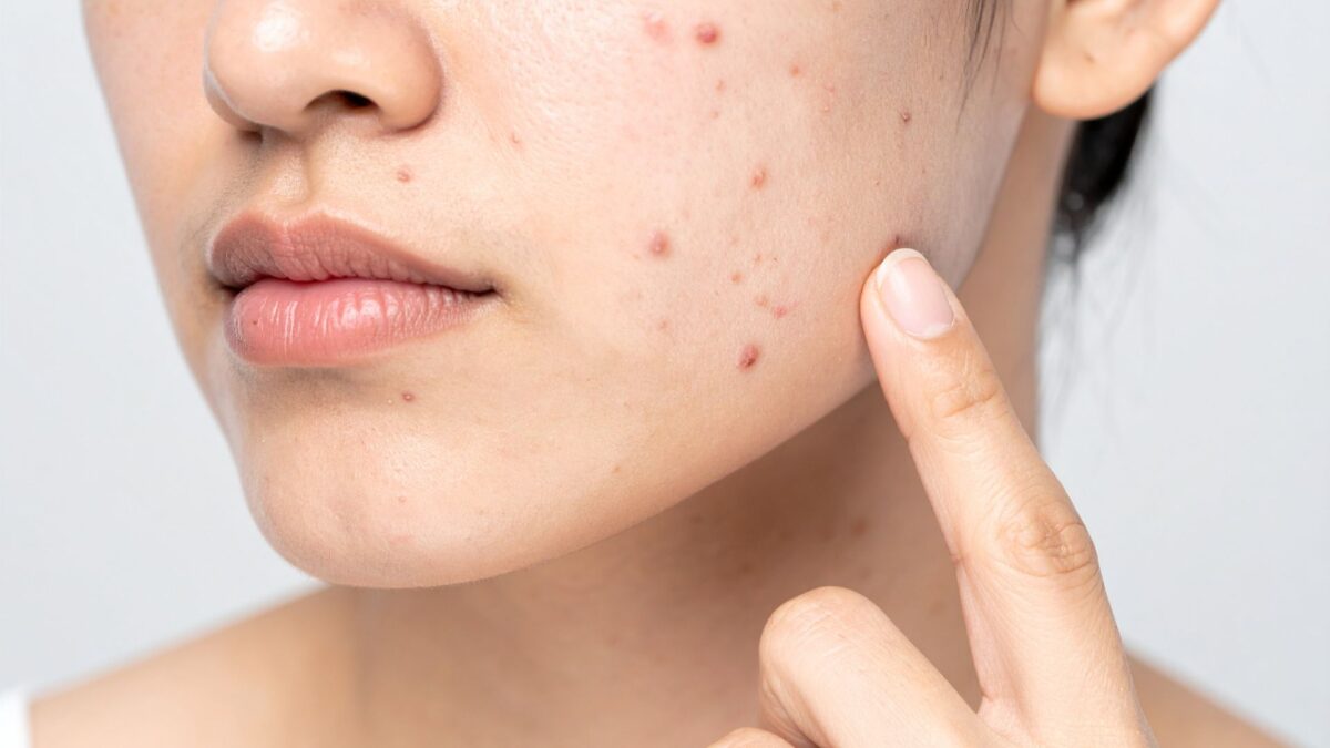 hormonal acne on face with skincare ingredients that help reduce flare ups