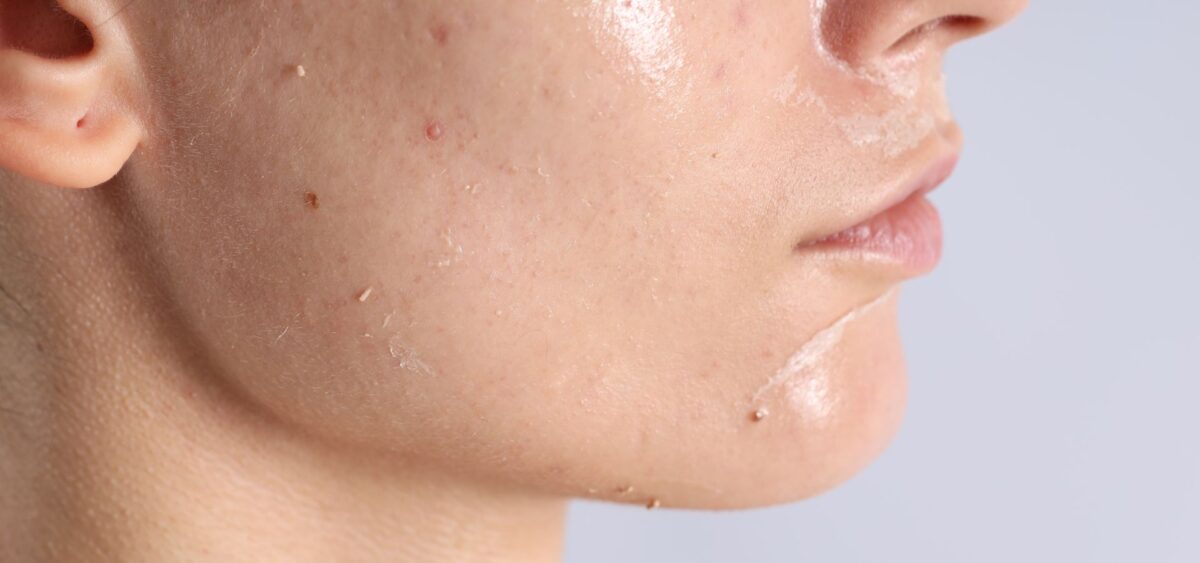 Best moisturizer for oily acne open pores skin that controls oil and minimizes the appearance of pores