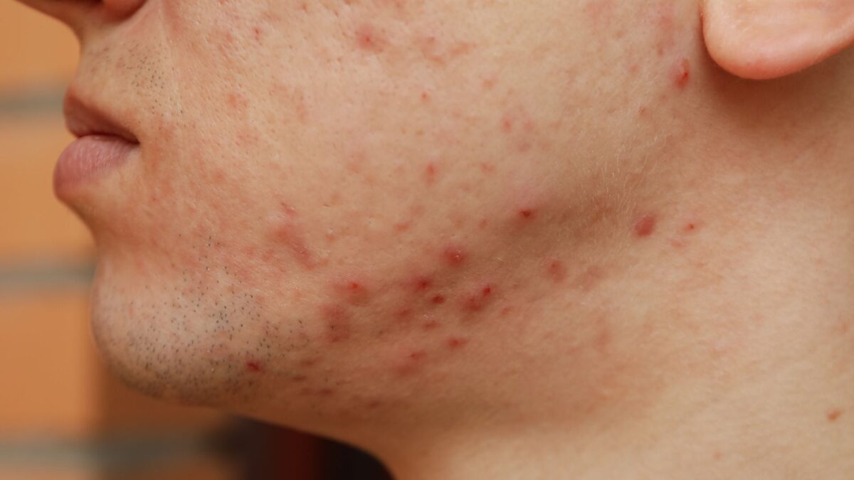 clean beauty products for acne prone skin with natural skincare ingredients