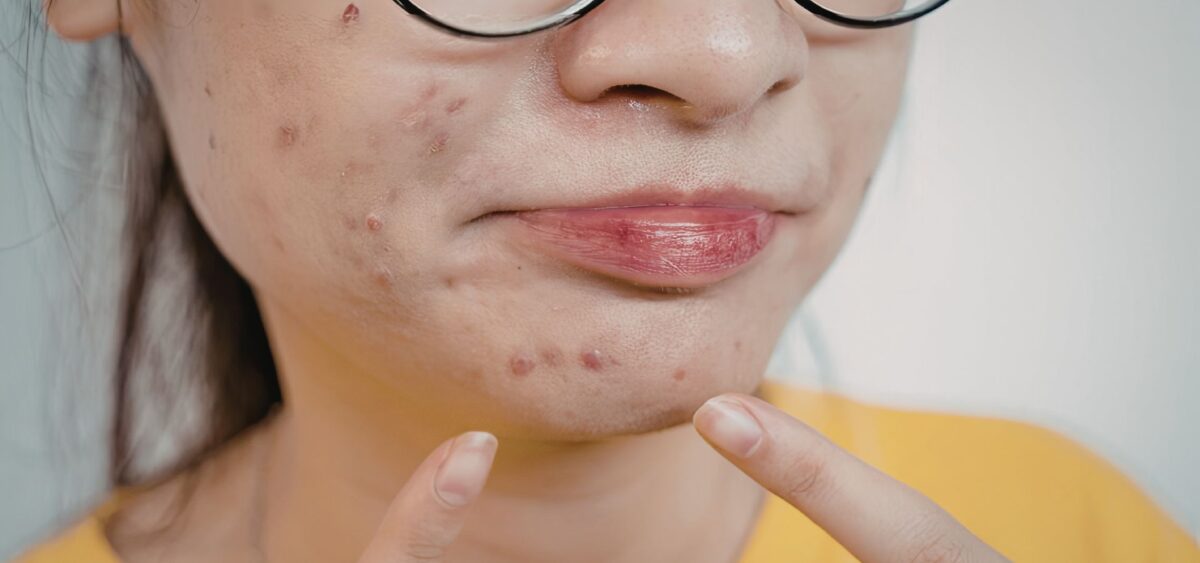 Dermatologist recommended acne products including cleansers, treatments, and moisturizers for clear skin