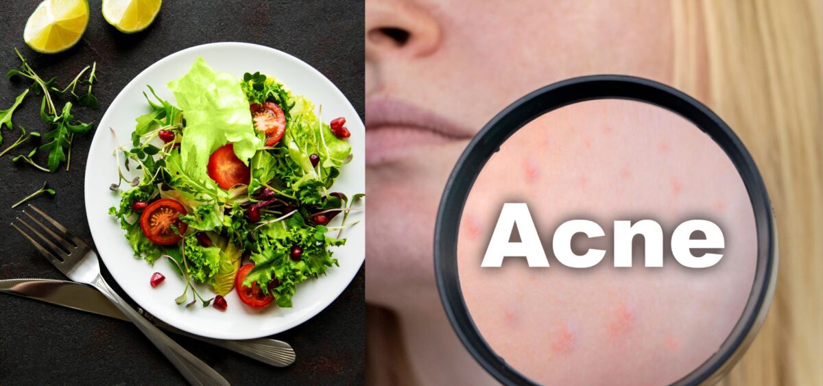 How diet affects acne including impact of sugar, dairy, and processed foods on skin health