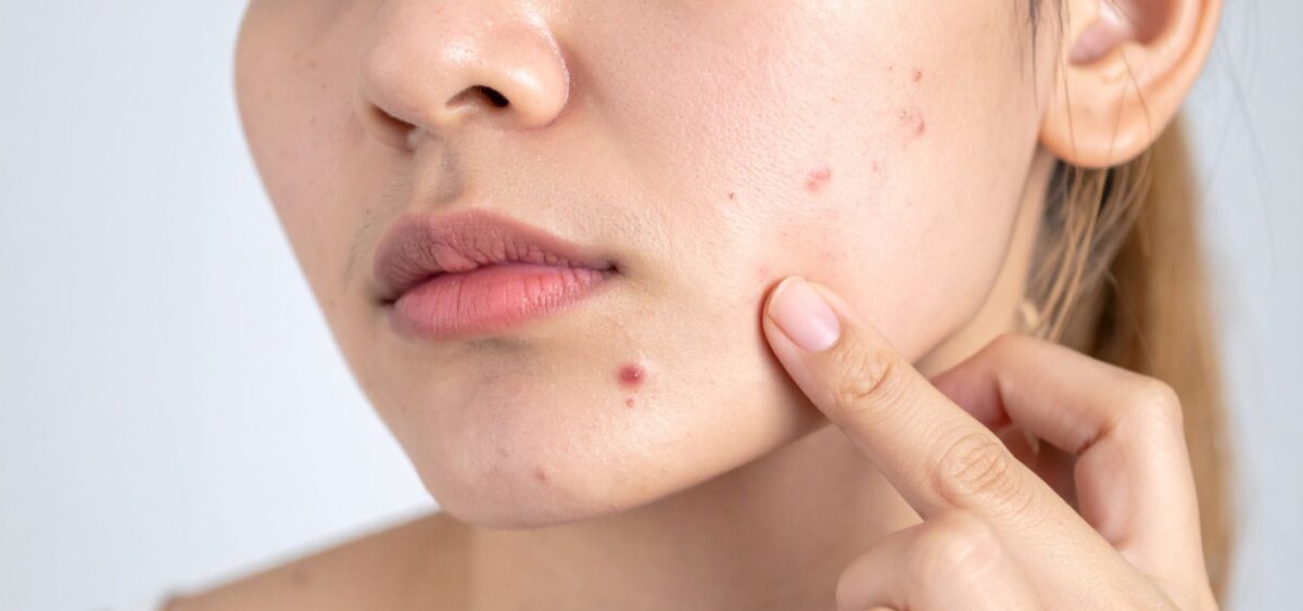 oily acne prone skin with pimples and natural skincare routine for oil control