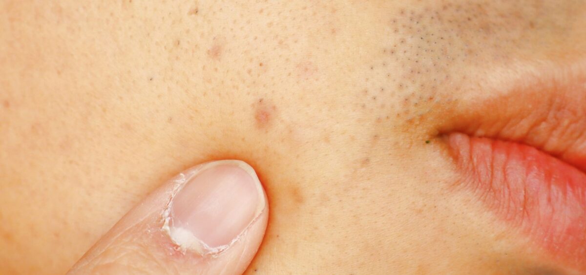 How to prevent acne scars naturally using gentle skincare, natural remedies, and proper acne care