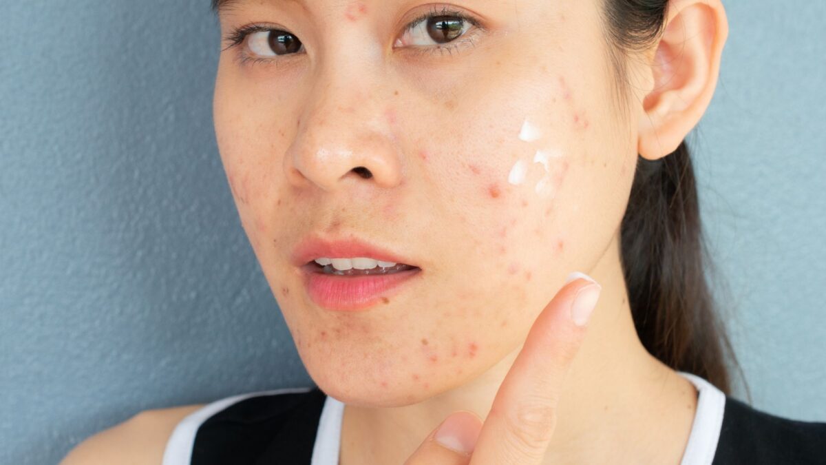 how to use best drugstore acne products in skincare routine for clear skin