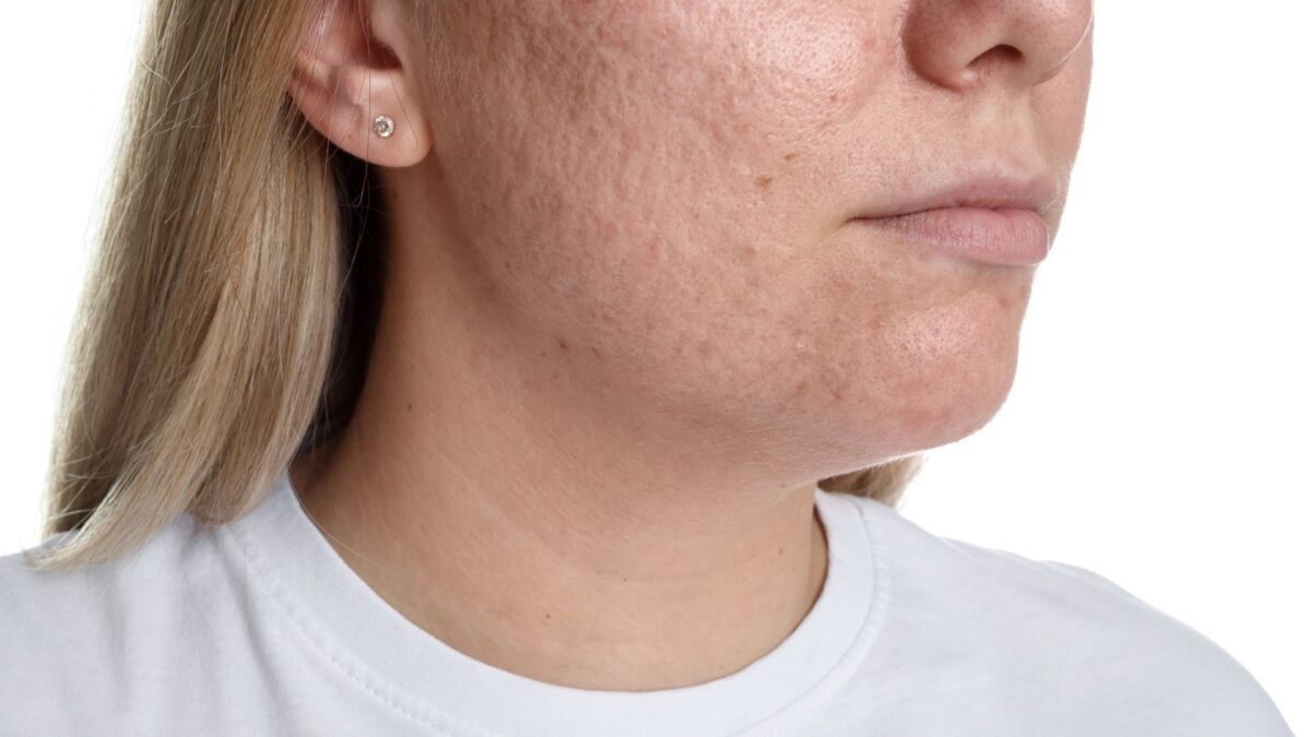 moisturizer for oily acne skin with open pores and lightweight hydration