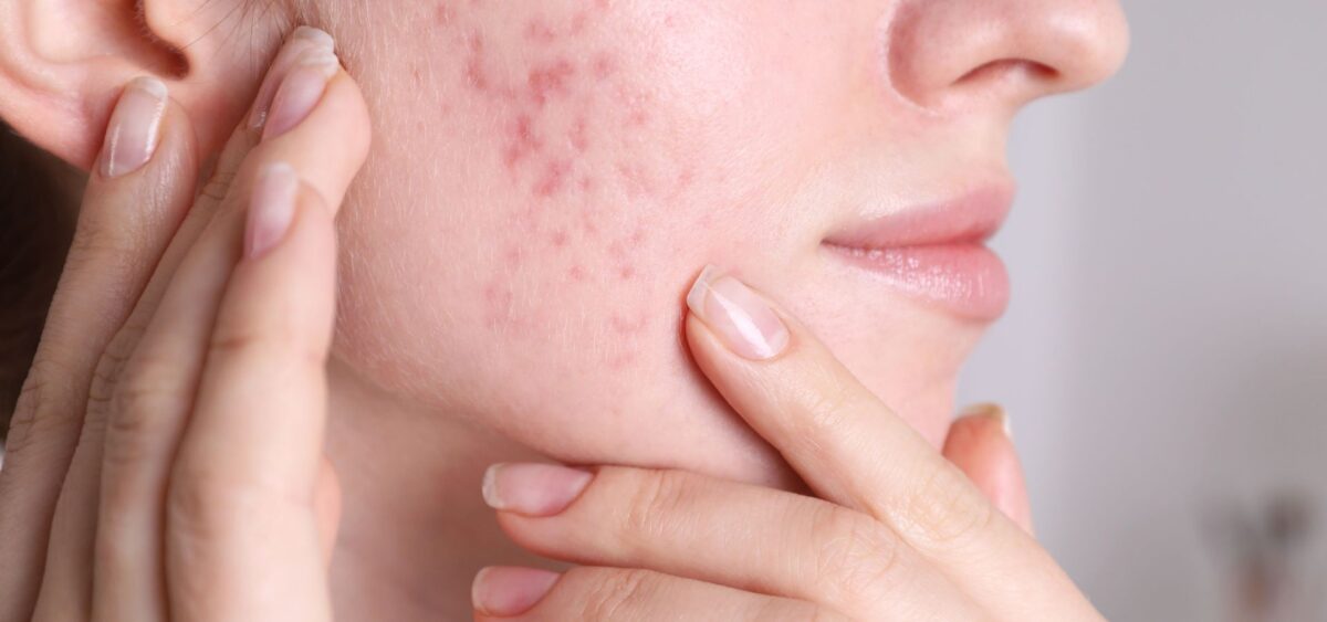 Morning and night routine for acne prone skin including cleansing, treatment, and moisturizing steps