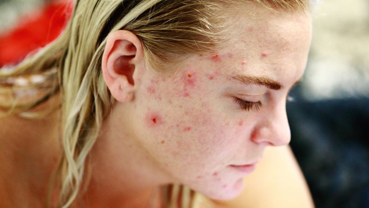 cystic acne on face with tips to prevent acne scars naturally