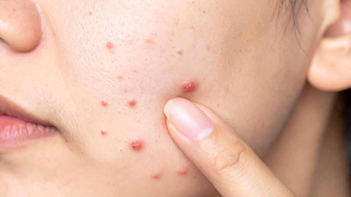 oily acne prone skin with pimples and natural skincare routine for oil control