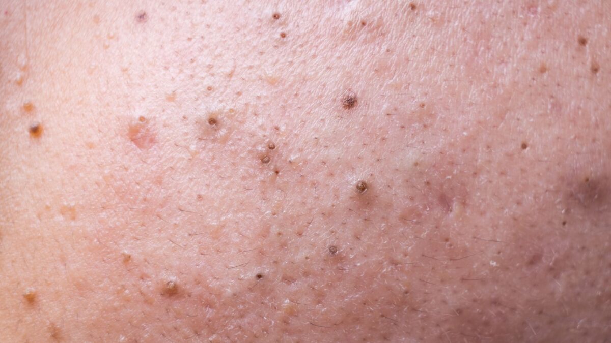 salicylic acid vs benzoyl peroxide for acne and blackheads treatment comparison