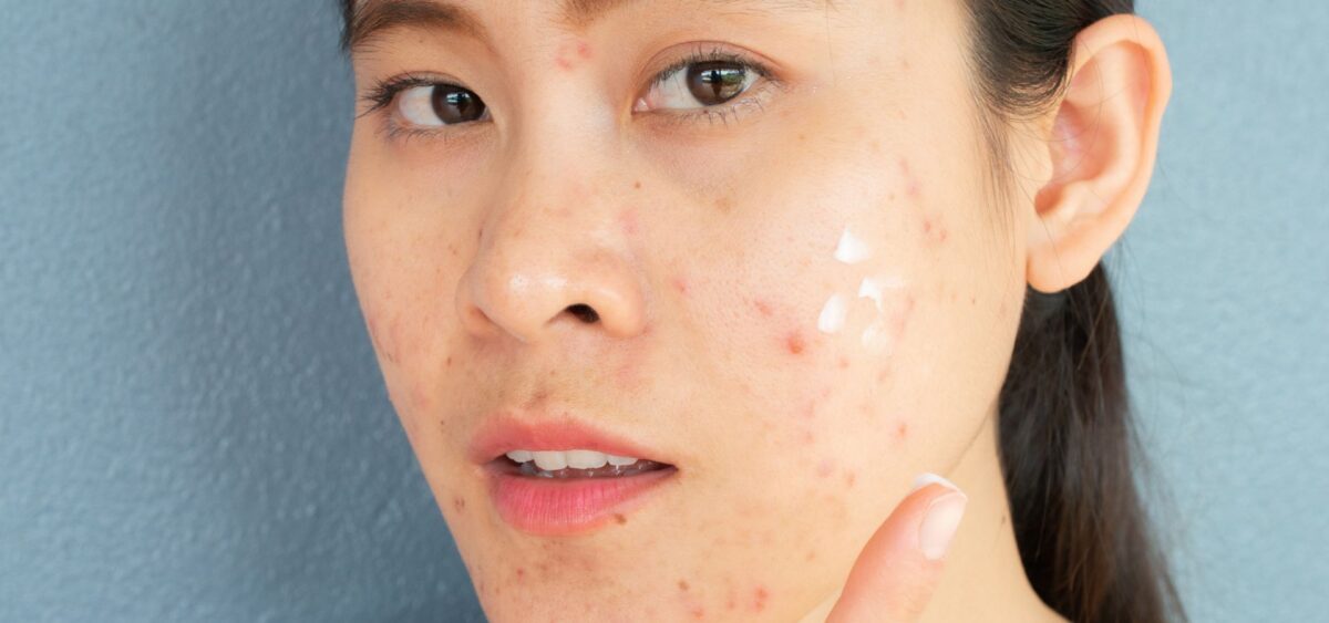 Salicylic acid vs benzoyl peroxide for acne showing differences in treating blackheads, whiteheads, and inflamed pimples