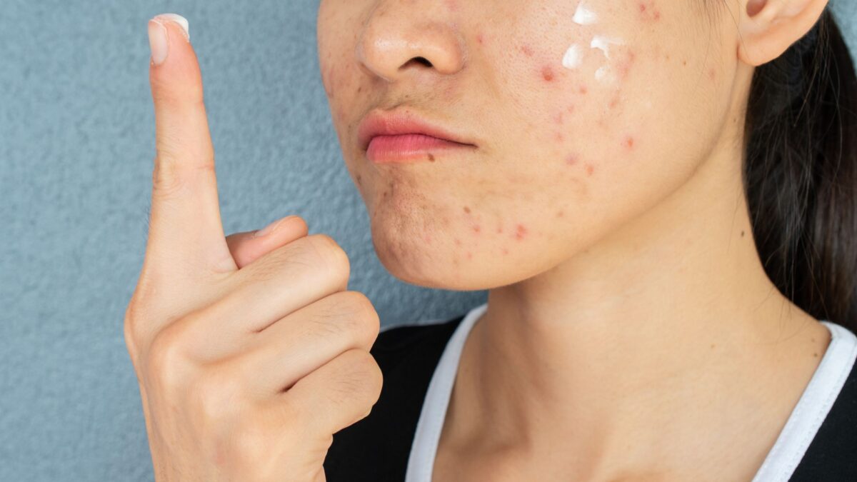 summer acne control routine step by step for oily acne prone skin