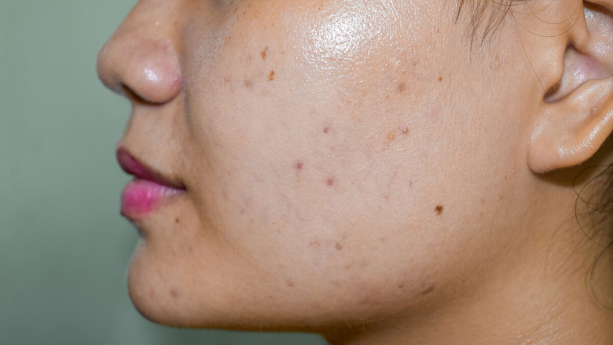 dark spots after acne with spot treatment for clearer skin