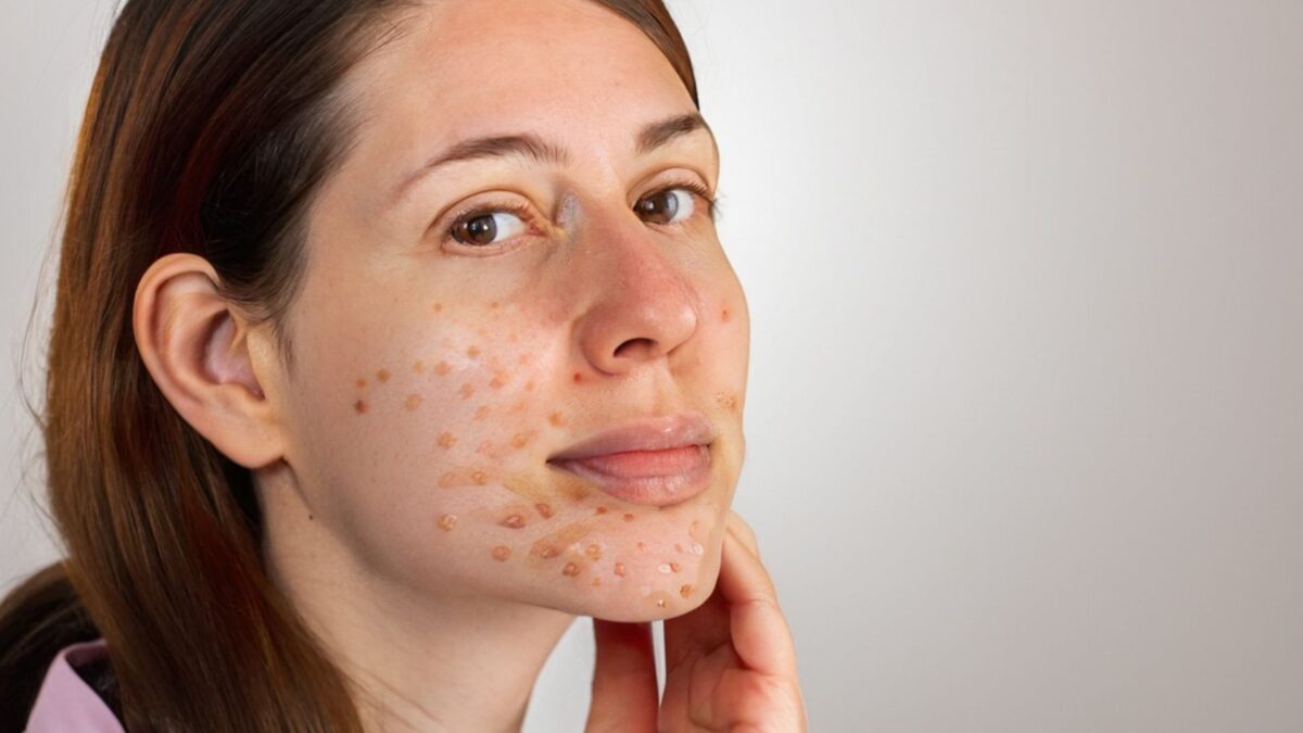 adult acne in women with visible pimples and skincare treatment routine