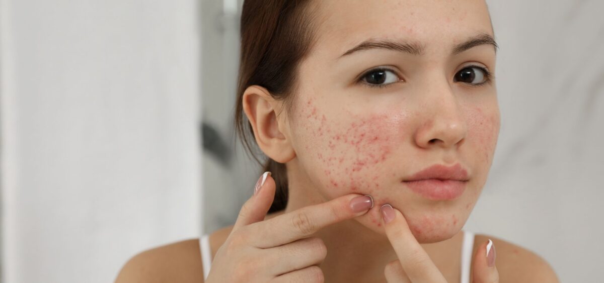 What causes adult acne in women including hormonal imbalance, stress, and skincare triggers