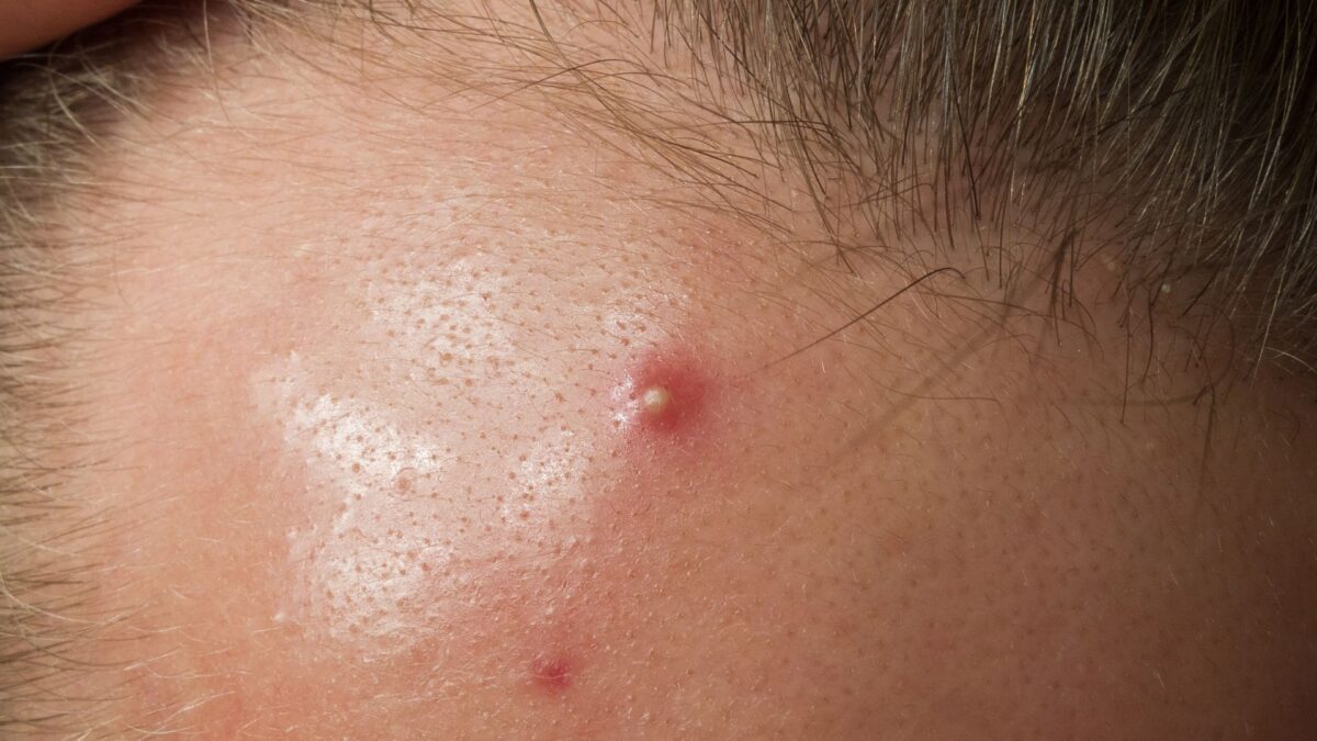 winter skincare for oily acne prone skin with hydration and acne control